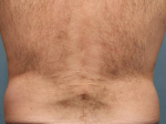 Coolsculpting Case 112 Before